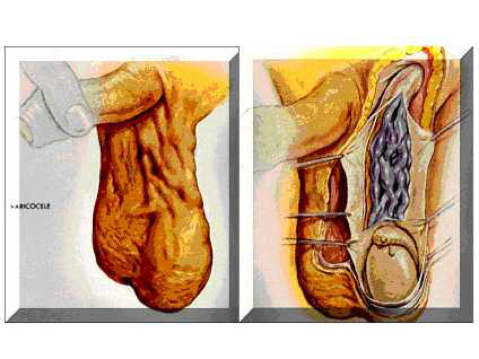 精索静脉曲张阴囊照片图片