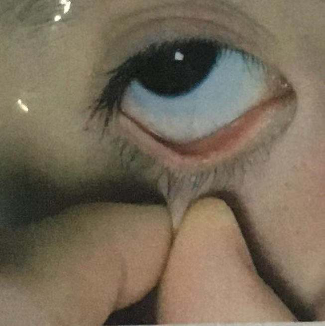 儿童点眼药的方法_汤小娇医生文章_重庆医科大学附属儿童医院-微医