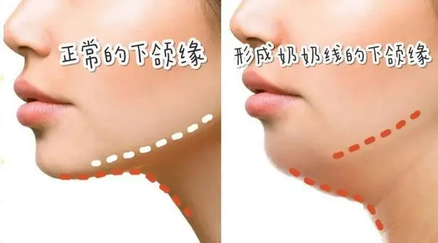 如何可以拥有完美的下颌线