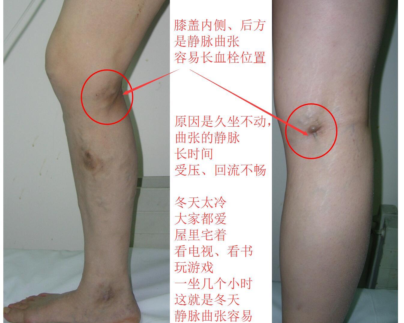 毒素,代谢废物这些有毒物质瘀在腿上排泄不掉,久而久之就容易形成血栓