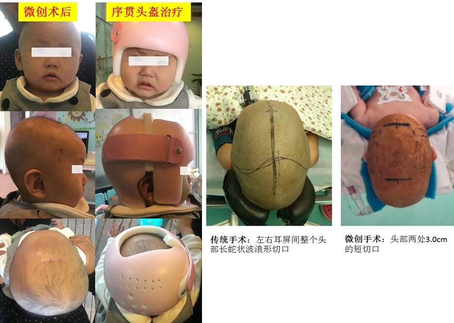 内镜头盔微创治疗颅缝早闭小切口无需重建眼眶