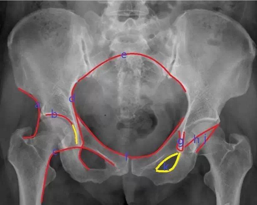 骨科读片骨盆x线平片解读