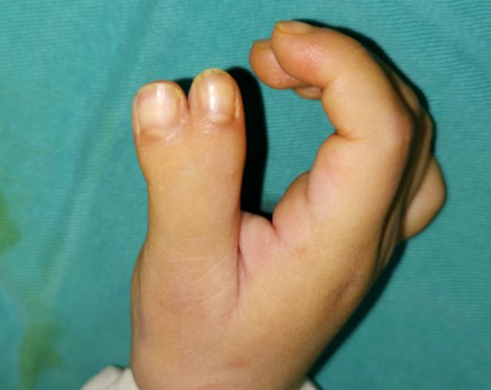 这是多指还是并指什么时候做手术比较好