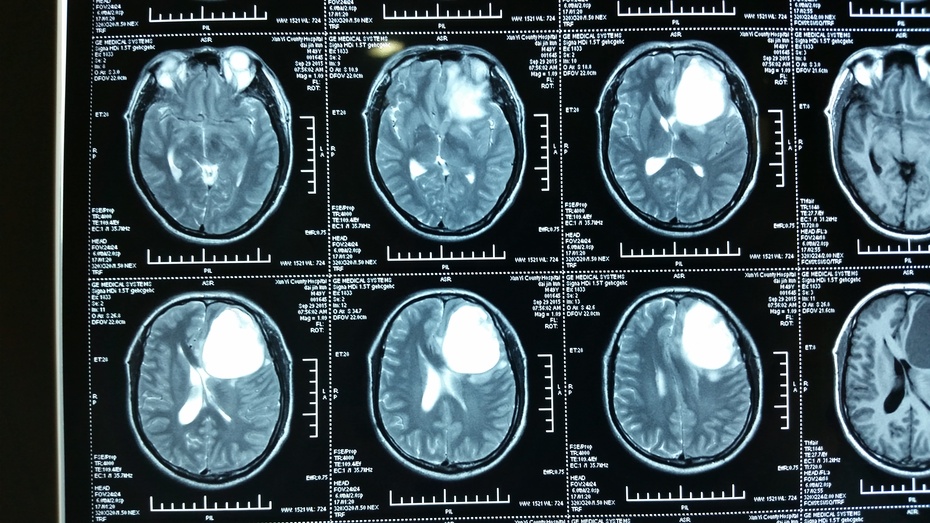 胶质瘤手术治疗实例分析