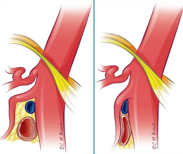 什么是胡桃夹综合征/症?与精索静脉曲张有何关联?