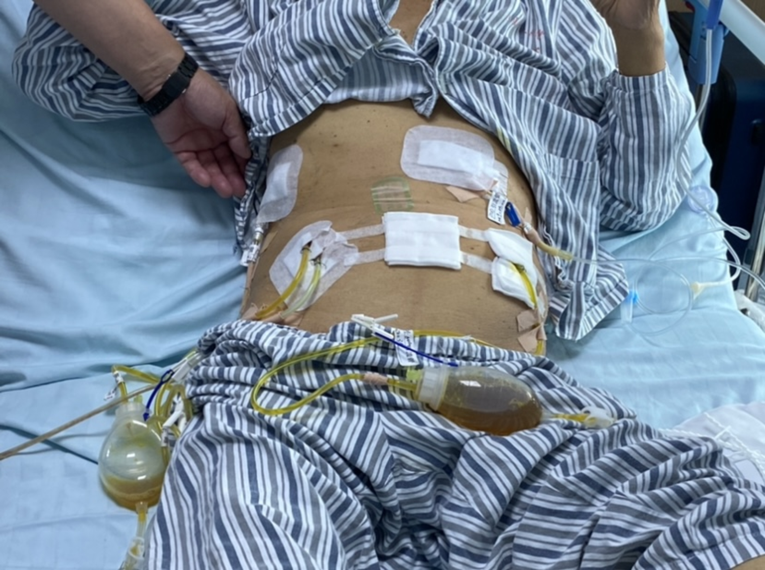 抗癌故事晚期胰腺癌身上被放置五根引流管痛苦续命钱祝银主任一次手术