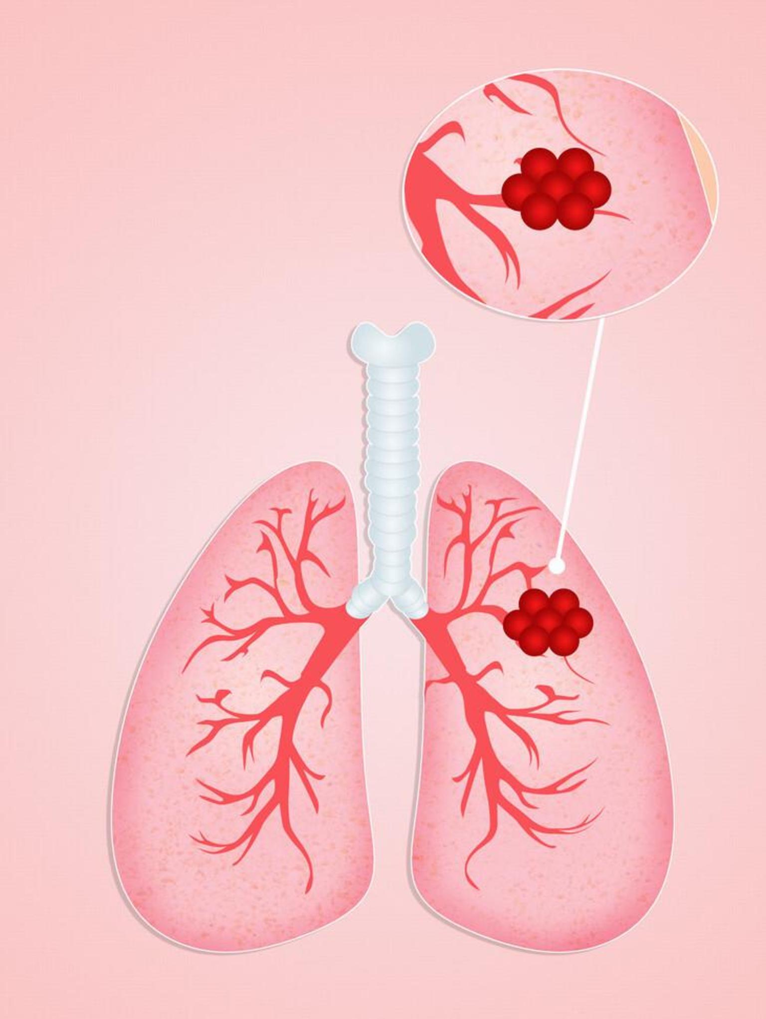 肺结节为何要做靶扫描?可更加具体地提供结节的细节,诊断更准确