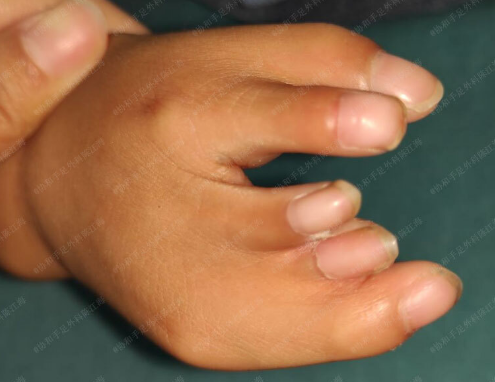 6个月宝宝手指特别小短指怎么治疗手术后恢复需要多长时间