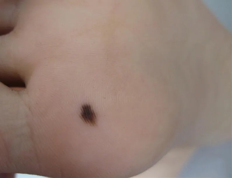 交界痣↓到底哪些是痣,哪些不是?上面这对话,是我经常碰到的咨询!