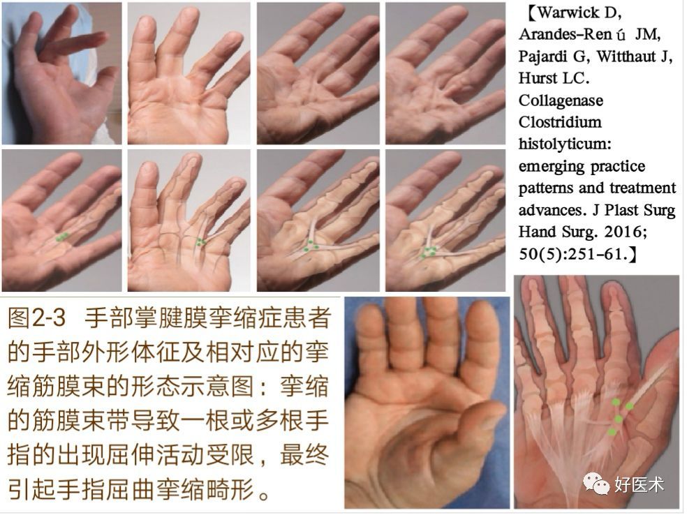 ①掌侧 grayson韧带,手指腱膜包绕指神经血管束,其中包括:④指蹼韧带