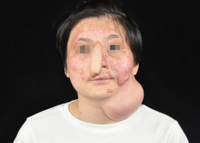 扩张器治疗面颈部大面积瘢痕常见问题