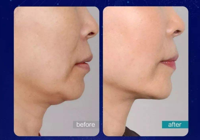 下颌缘提升针靠谱吗