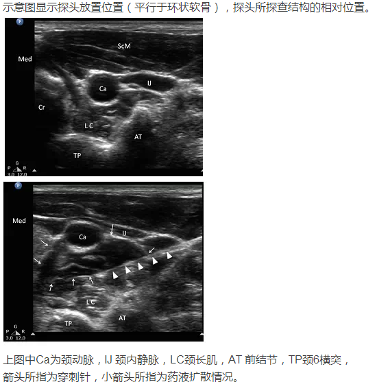 目前利用超声进行星状神经节阻滞越来越多,超声具有携带方便,操作简单