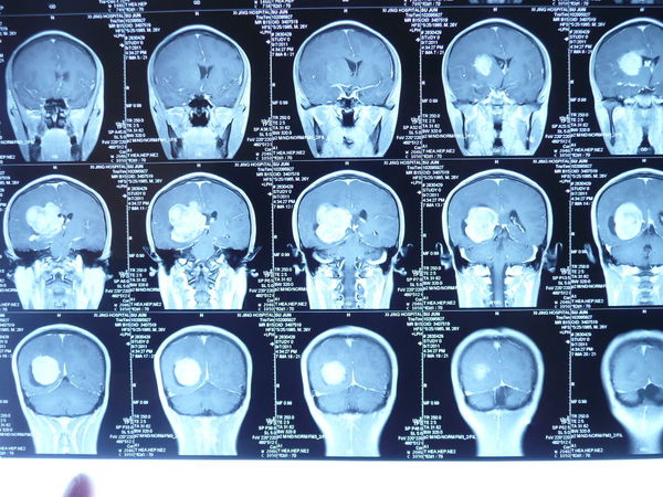 西京医院颅内巨大肿瘤治疗实例图组