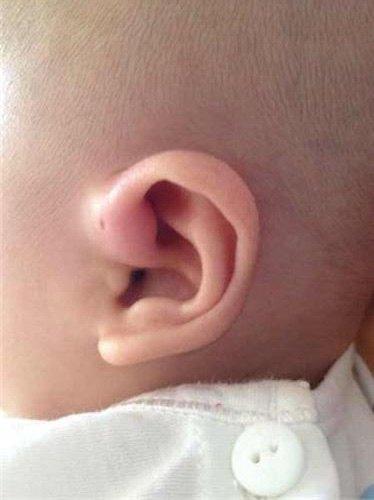 耳前小洞是瘘管容易感染要重视 - 微医(挂号网