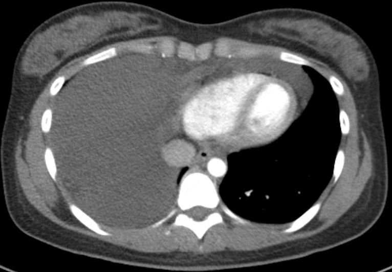 前纵隔结节前纵隔肿块胸腺囊肿thymiccyst和胸腺瘤如何区别需要手术吗