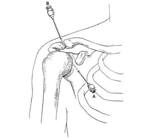 髋膝踝肩肘腕关节穿刺图文详解