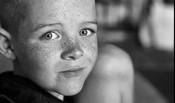 杭州三院皮肤科徐瑾科普雀斑是如何形成的