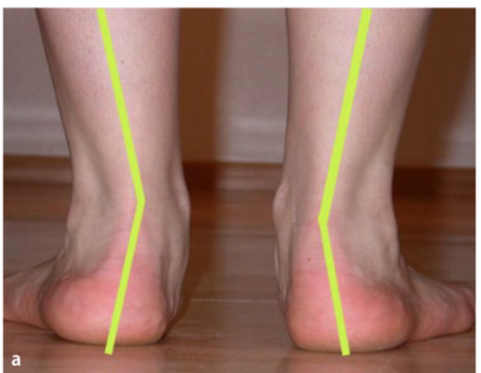 如何判断自己是不是扁平足