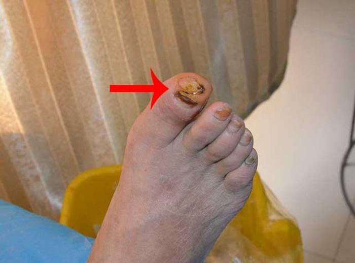 糖尿病引起的脚疼指甲发黑怎么治疗