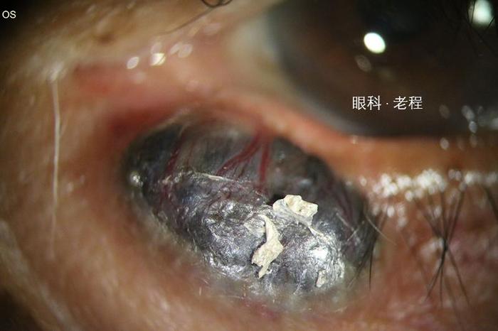 眼睑恶性肿瘤系列之基底细胞癌 - 微医(挂号网)