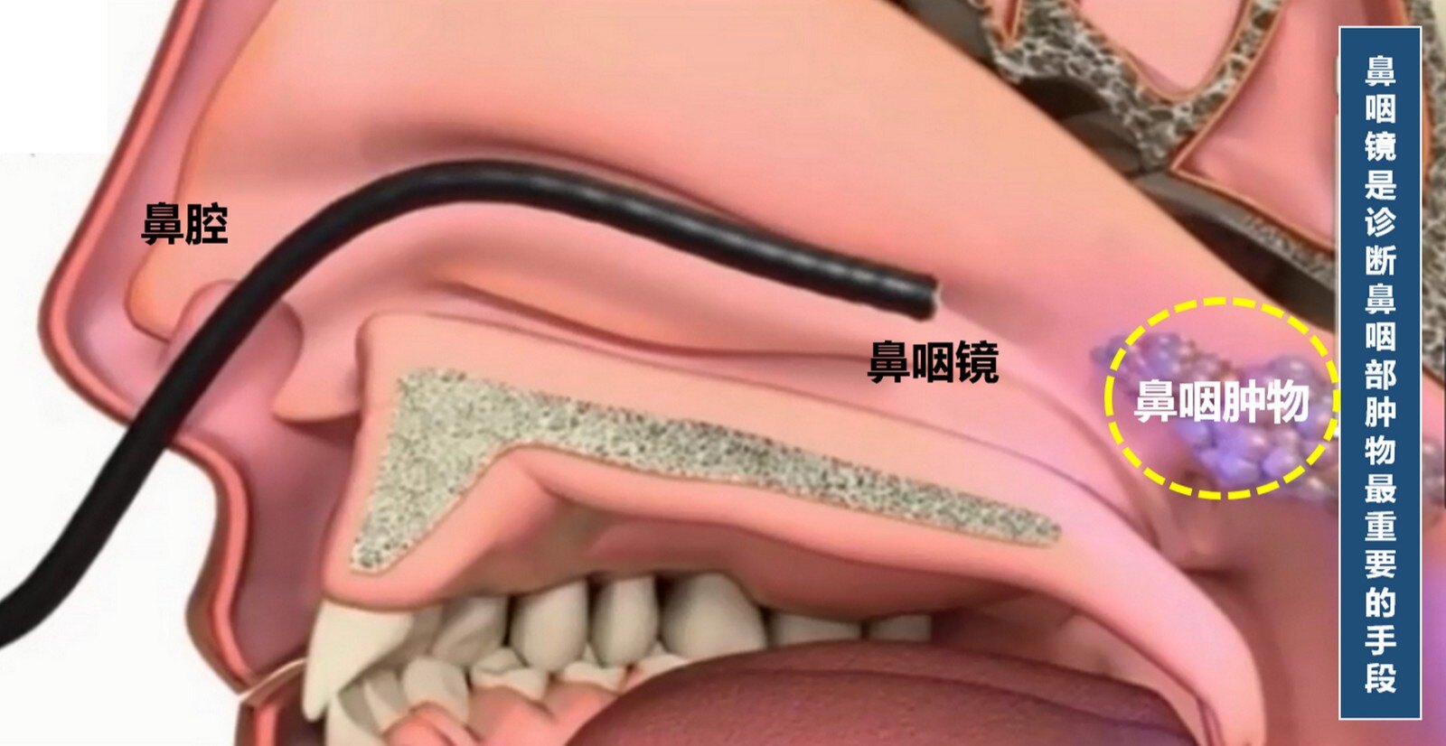 惊闻香港名导因鼻咽癌晚期离世,鼻咽癌如何早期发现?