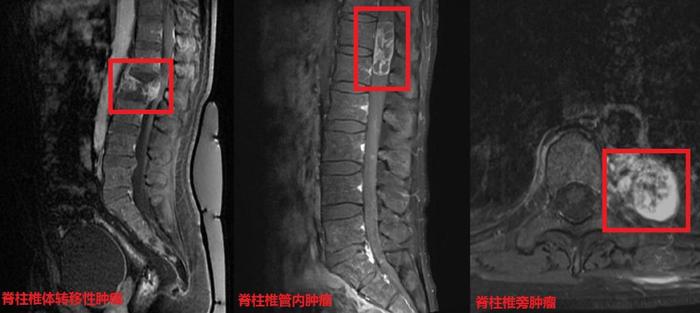 (脊柱转移瘤颈椎肿瘤胸椎肿瘤腰椎肿瘤)