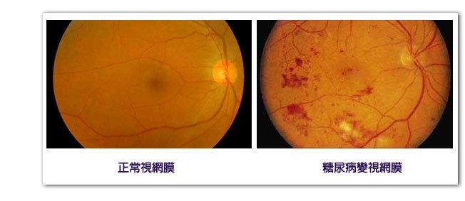 玻璃体切割手术的原理_175眼科玻璃体切割术的健康宣教(2)