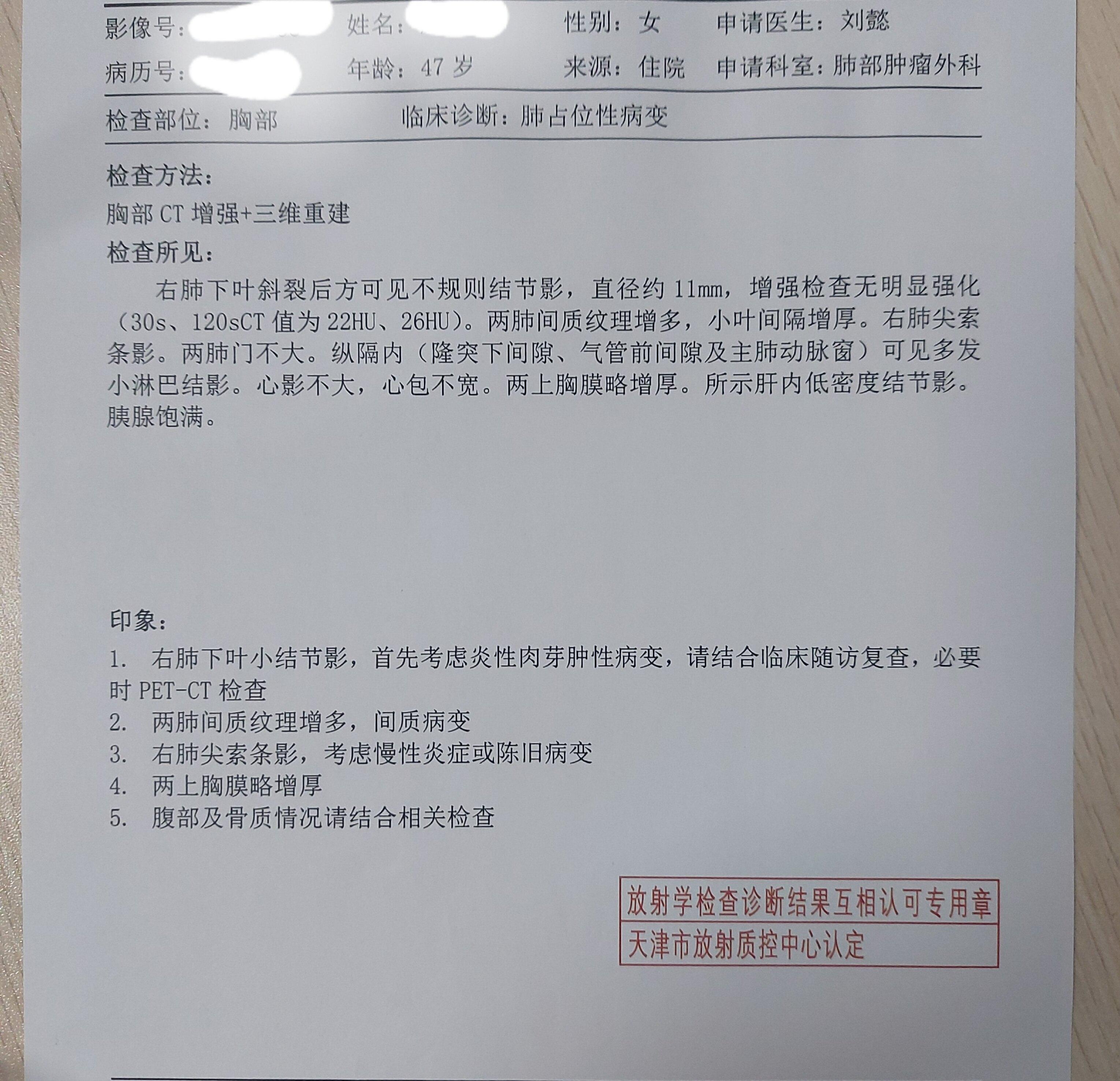 刘懿博士说肺癌一三亖一肺结节ct报告是良性我力主手