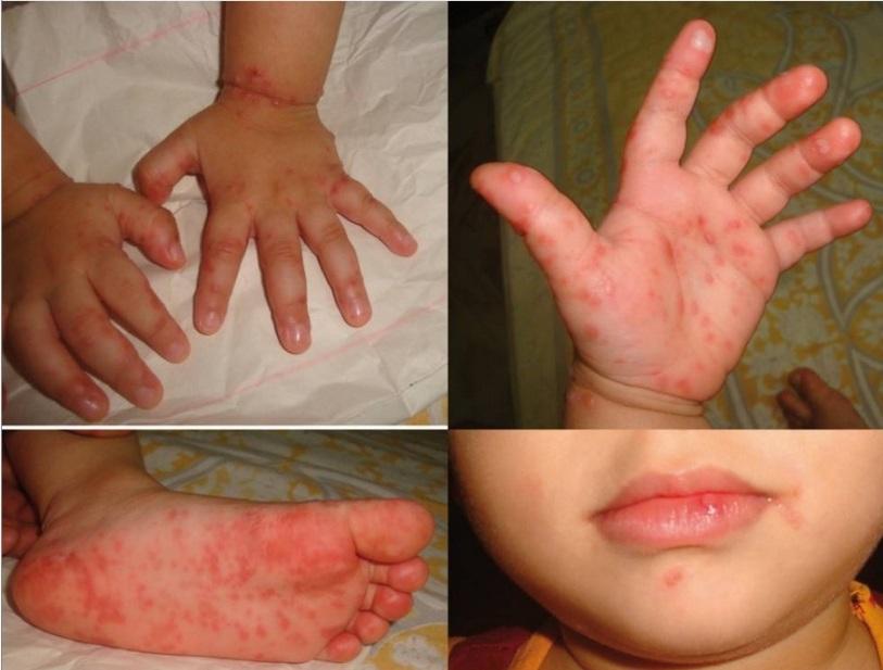 病毒疹和病毒性皮肤病