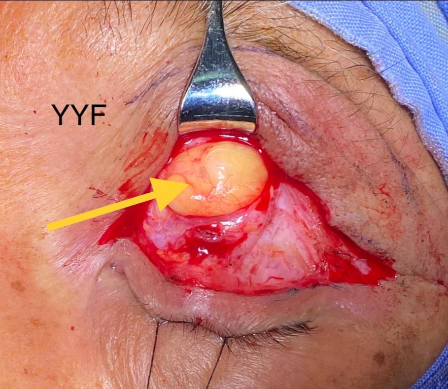 双眼睑皮肤松弛的手术矫正解决倒睫外观以及视线遮挡