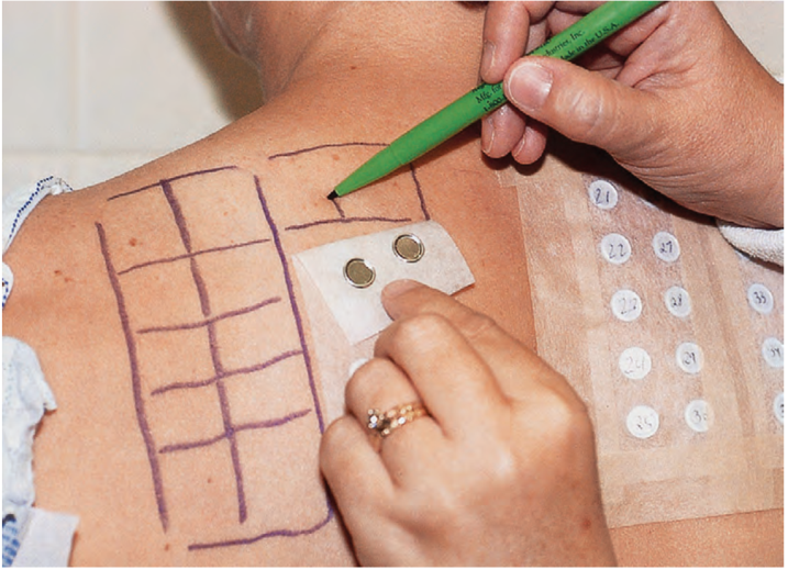 什么是斑贴试验? - 微医(挂号网)