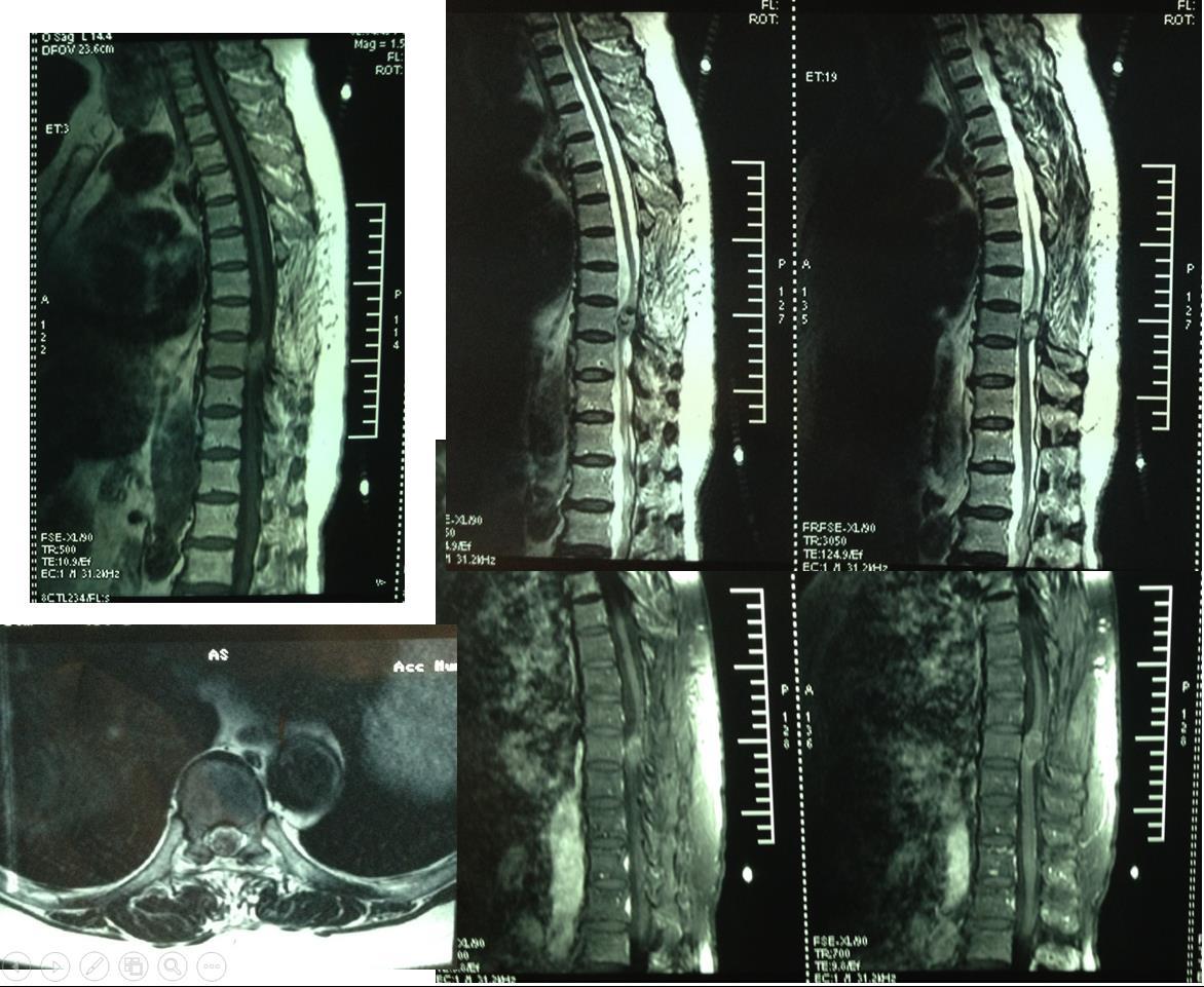 胸段脊髓海绵状血管瘤的外科治疗_陈鑫医生文章_复旦大学附属肿瘤医院