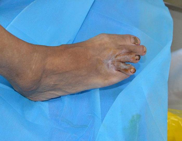 糖尿病患者足部畸形要警惕糖尿病足