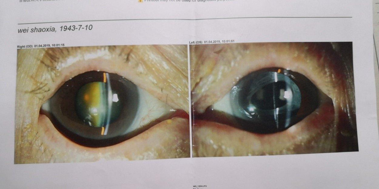 原来经过青光眼手术以及长期的青光眼和浅前房损伤,魏阿姨的角膜内皮