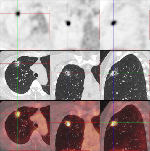 空泡型磨玻璃结节肺癌 _谢冬医生文章_上海市肺科医院-微医(挂号网)