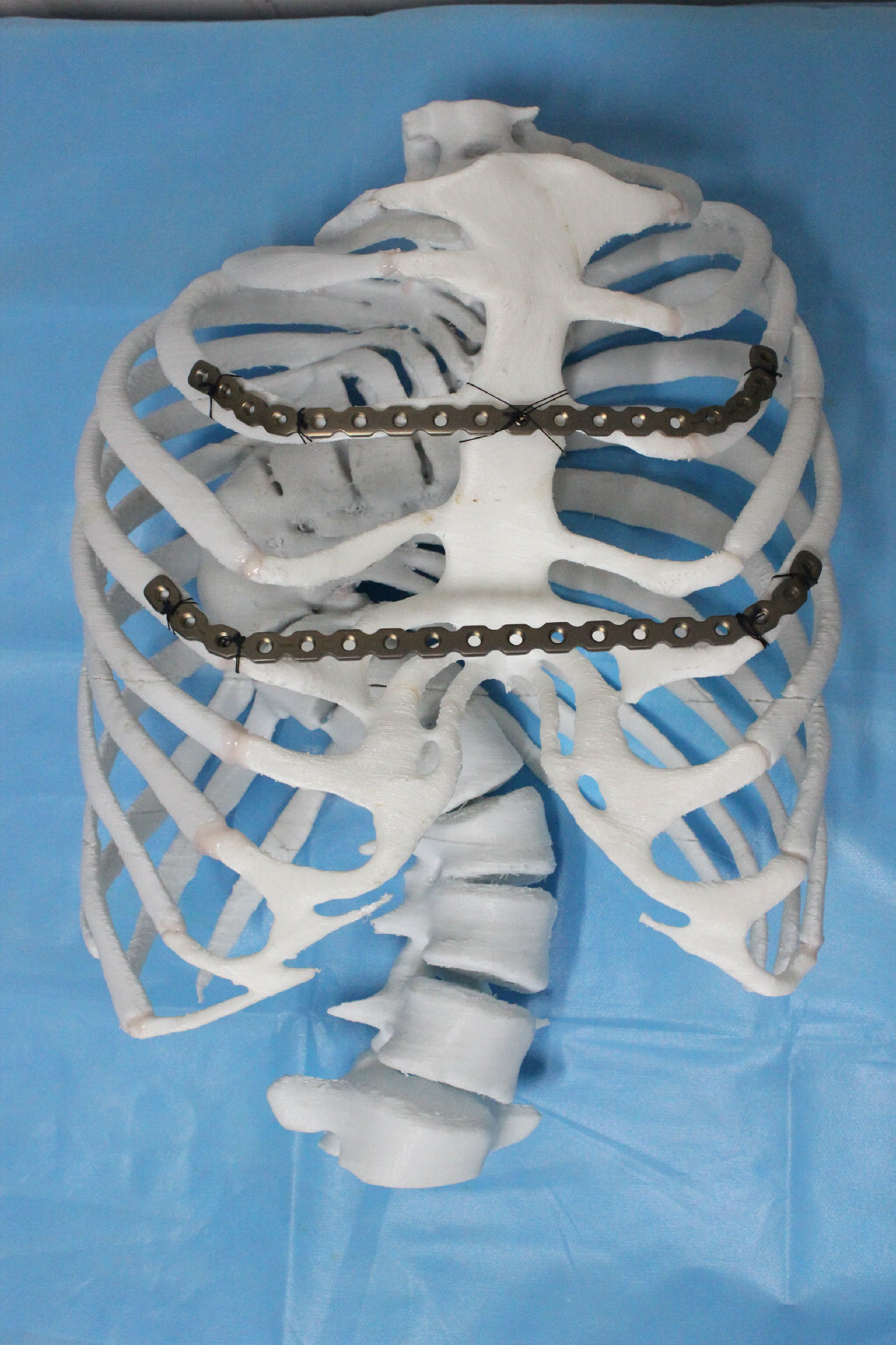 我课题组完成一例极重度漏斗胸的矫正手术