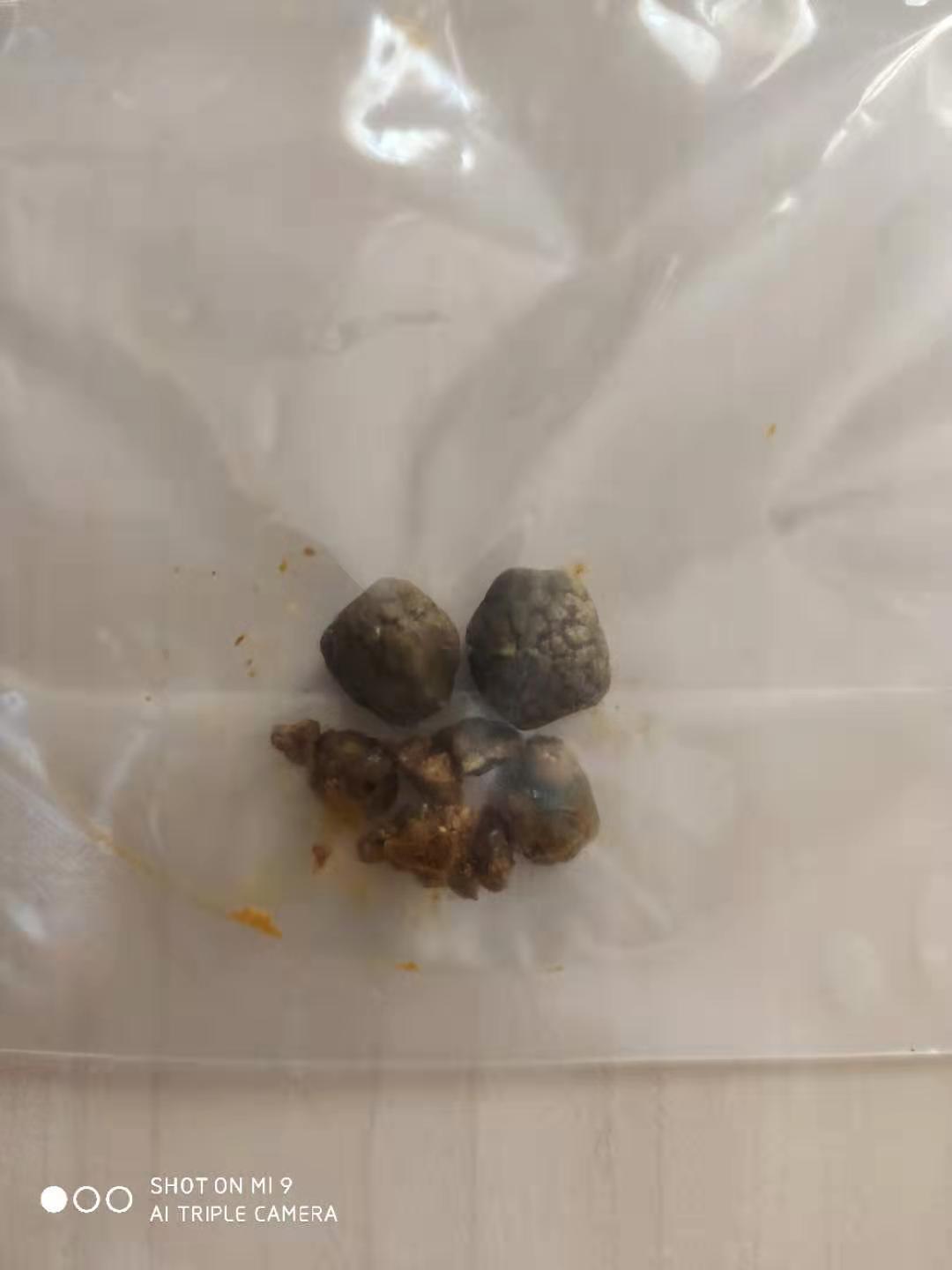 术前超声提示胆囊多发结石,但没有泥沙样结石,脂肪餐实验显示胆囊收缩