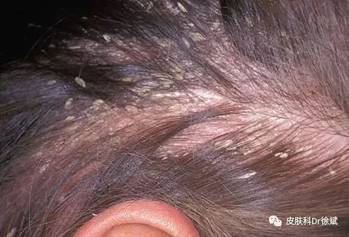 答:发生于头皮部位,开始为轻度潮红斑片,上覆灰白色糠状鳞屑,伴轻度