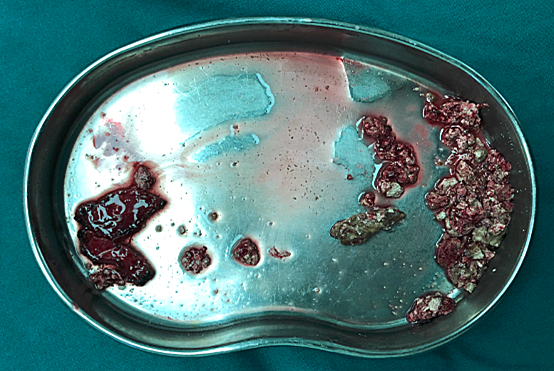 鹿角型肾结石的治疗