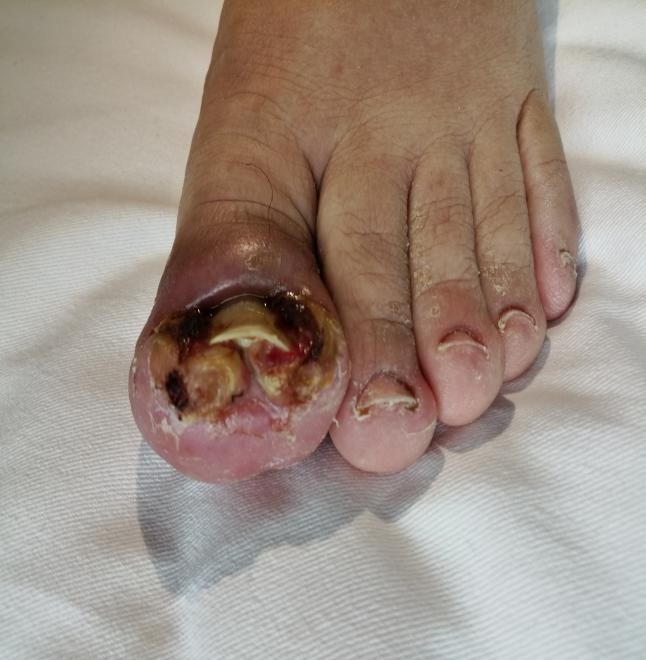 脚趾甲沟炎的症状图片图片