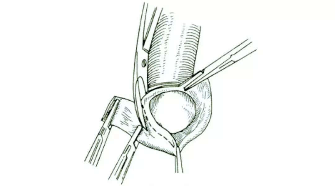 传统包皮环切术2.商环包皮环切术3.