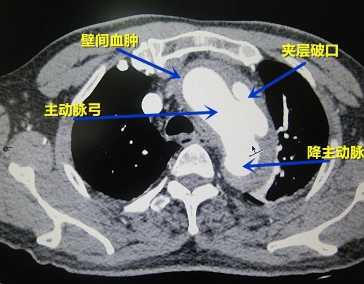 手术科普主动脉瘤的外科治疗策略