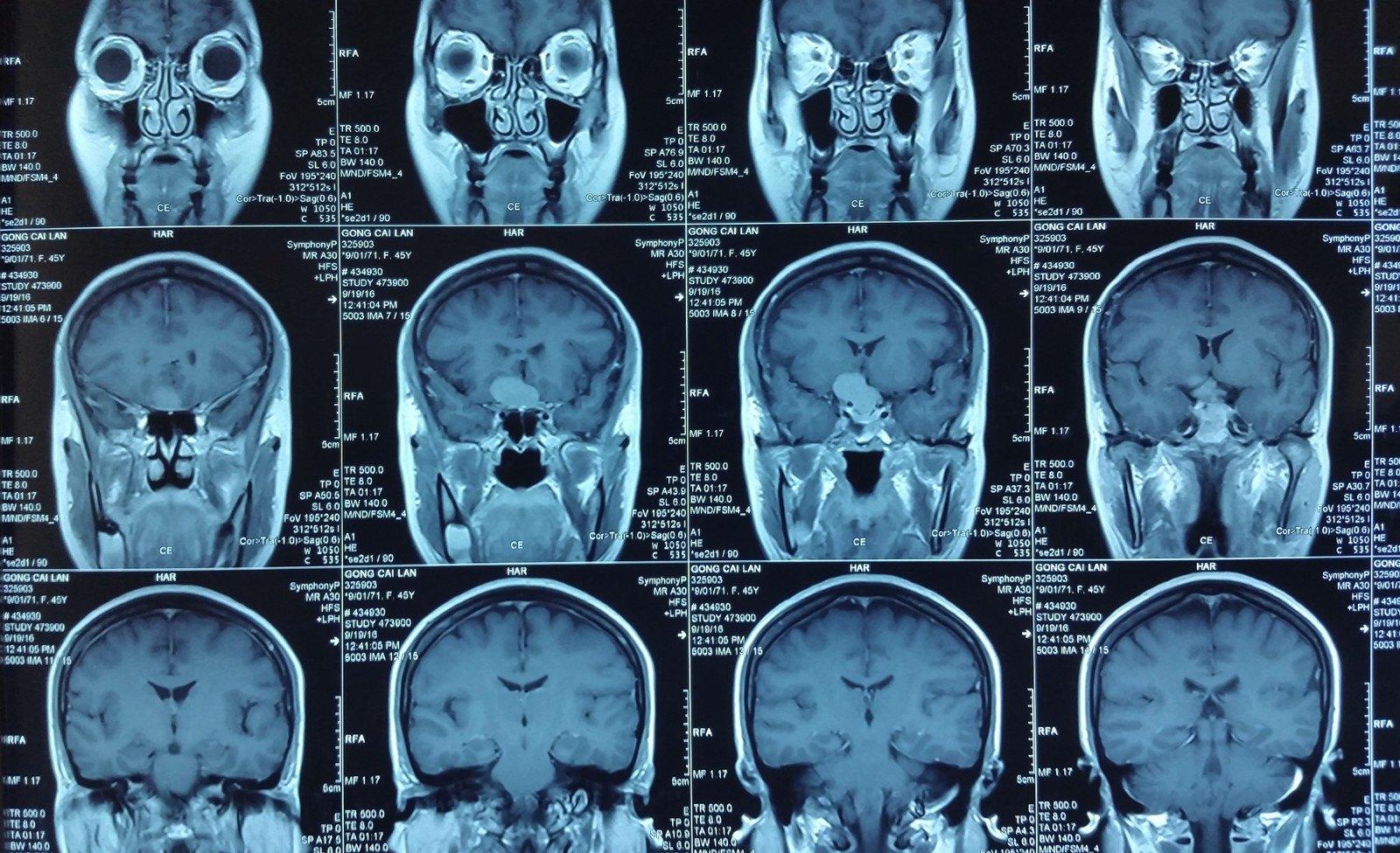 解读脑瘤“高配”手术——现代神经外科辅助“神器”有哪些？|生理|影像|实时|-健康界