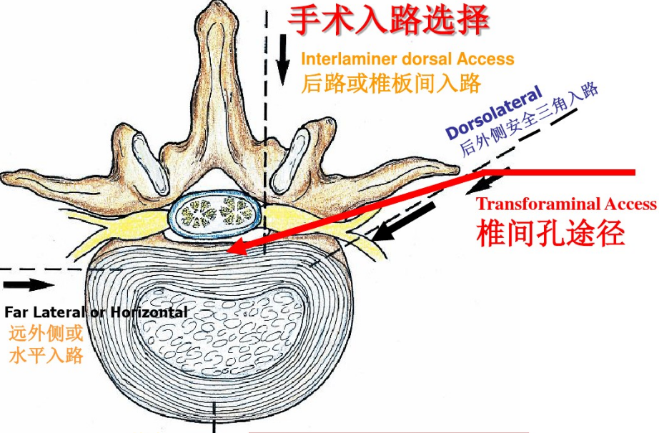 腰椎间盘突出微创手术治疗 图文详解全程攻略 罗斌医生文章 广东省中医院二沙岛分院 微医