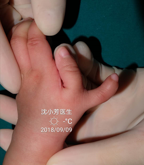 因此更需要慎重选择医生:v型:这个类型拇指从掌骨分叉出来,掌指关节