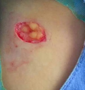 毛母质瘤1例_纪秀军医生文章_济南市人民医院-微医