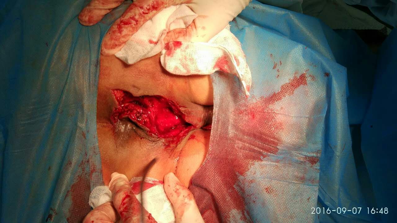 一个在肛门左前阴囊根部的肛周脓肿