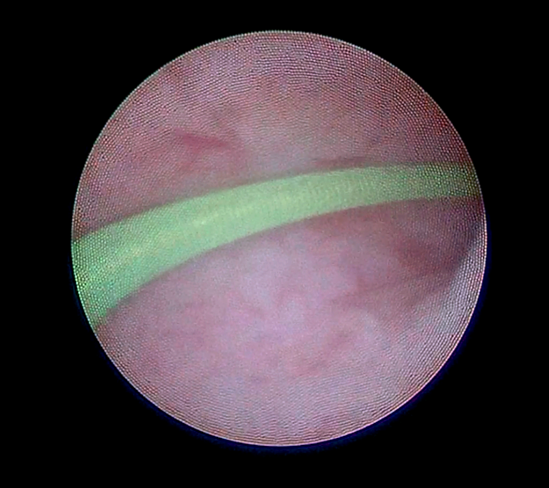 输尿管镜下钬激光碎石术的注意事项