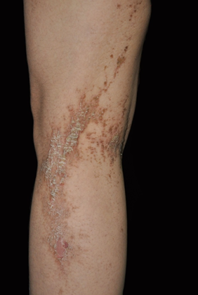 会遗传的表皮痣